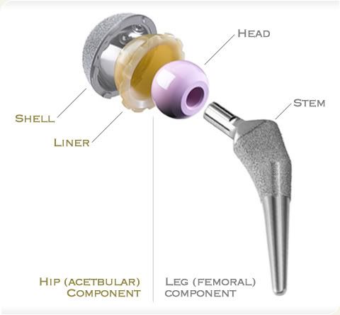 bethlehem pa resurfacing hip replacement