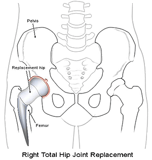 hip replacement problems attorney in allentown